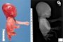 Caudal regression syndrome with lumbosacral agenesis and situs (...)