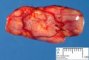 Cellular schwannoma