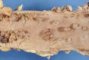 Familial adenomatous polyposis