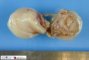 Localized neurofibroma in neurofibromatosis type 1