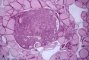 Microscopic medullary thyroid carcinoma (PMID:10843288)