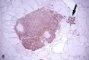Microscopic medullary thyroid carcinoma (PMID:10843288)