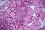 Microscopic medullary thyroid carcinoma (PMID:10843288)