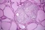 Amyloid microscopic medullary thyroid carcinoma (PMID:10843288)