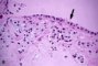 C-cell hyperplasia with amyloid microscopic medullary thyroid carcinoma (...)
