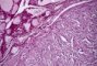 Spindle cell-microscopic medullary thyroid carcinoma (PMID:10843288)
