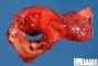 Subpleural hemorrhagic pseudocyst (etiology unknown)