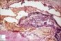 Zygomycosis (mucormycosis)