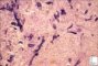 Zygomycosis (mucormycosis)