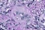 Nodal cryptococcosis (Cryptococcus neoformans)
