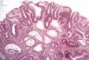 Tubulous microadenoma in FAP