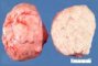 Uterine leiomyoma. Macroscopy.