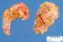 Adrenal congestion and hemorrhages in neonatal cardiogenic shock