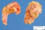 Adrenal hemorrhages in neonatal cardiogenic shock