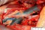 Lower vena cava (blue)