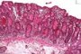 Intestinal cystic fibrosis with villous atrophy