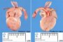 Dextrocardia