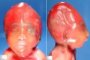Dolichocephaly in omphalocele-spina bifida association (18 weeks)