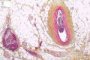 Epicardial small vein thrombosis
