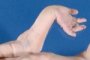 Hand deformation in an oligohydramnios sequence