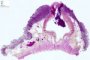Intestinal arteriovenous malformation