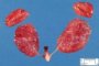 Non-syndromic non-obstructive multicystic renal dysplasia (BNOMRD)