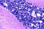 Pulmonary adenocarcinoma