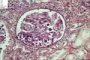 Systemic cryptococcosis