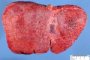 Micronodular cirrhosis in Wilson disease
