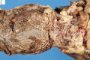 Crohn ileitis