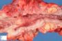 Crohn ileitis