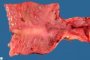 Ileocecal region with Crohn ileitis