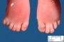 Foot post-axial polydactyly and syndactyly 2-3 in Smith-Lemli-Opitz (...)