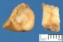 Hepatic localization in Hodgkin lymphoma