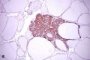 Microscopic medullary thyroid carcinoma (PMID:10843288)