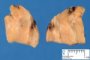 Parathyroid adenoma
