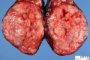Thyroid papillary carcinoma