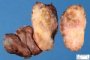 Thyroid papillary carcinoma