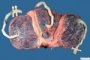 Triple pregnancy placenta