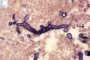 Zygomycosis (mucormycosis)