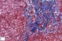 Portal fibrosis and biliary ductular proliferation in juvenile (...)