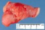 Meckel diverticula