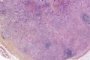 Nodal cryptococcosis (Cryptococcus neoformans)