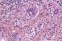 Nodal cryptococcosis (Cryptococcus neoformans)