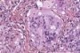 Nodal cryptococcosis (Cryptococcus neoformans)