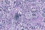 Nodal cryptococcosis (Cryptococcus neoformans)