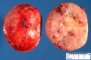 Aldosterone-secreting adrenocortical tumor