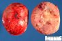 Aldosterone-secreting adrenocortical tumor