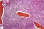 Bone marrow localization of classic Hodgkin lymphoma