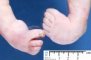 Club foot in oligohydramnios sequence